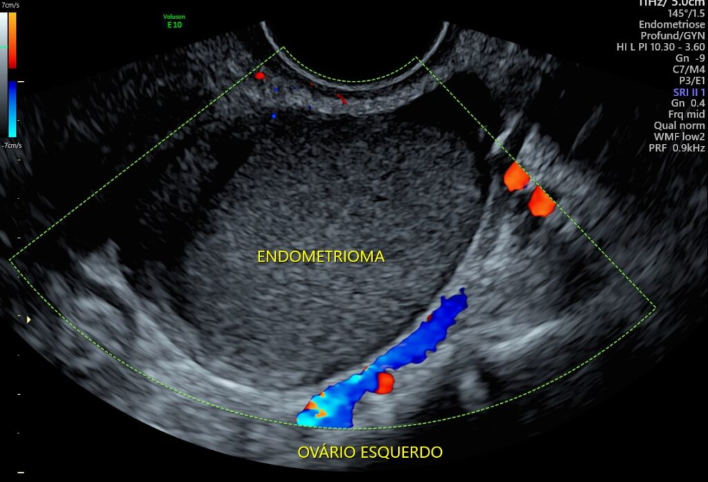 Descubra a diferença entre endometriose e adenomiose